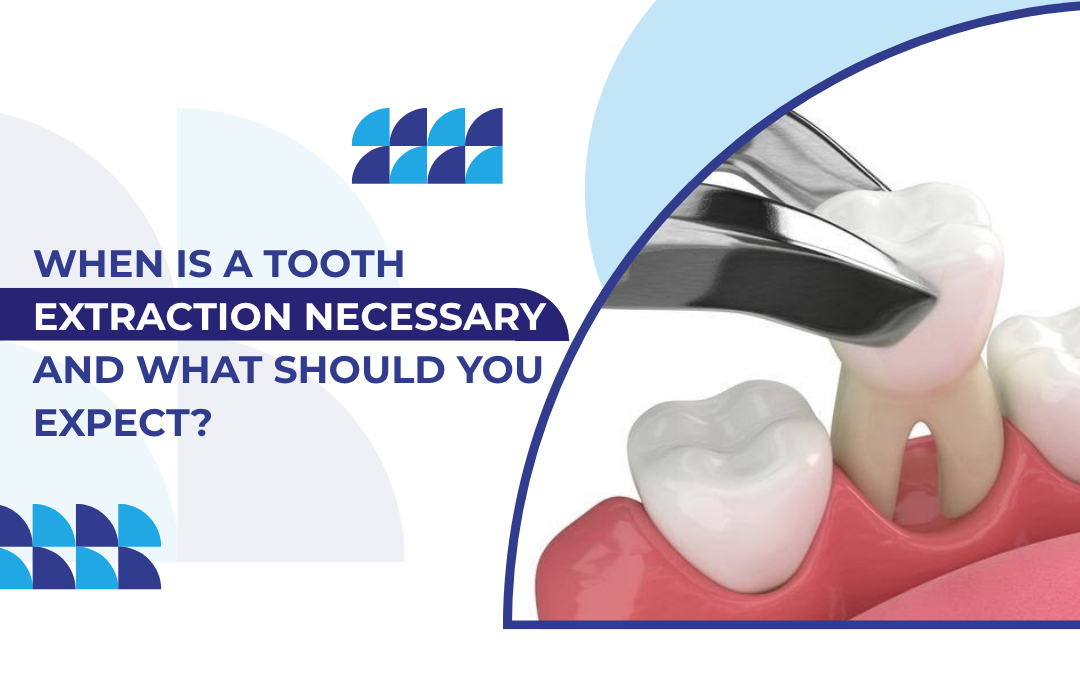 When Is a Tooth Extraction Necessary and What Should You Expect?