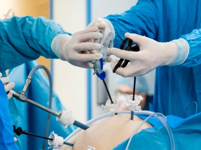 Surgeons in blue scrubs and gloves perform a laparoscopic abdominal surgery, inserting instruments through abdominal ports on a patient.