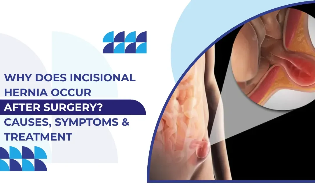 Incisional Hernia After Laparoscopic Surgery: Causes, Symptoms & Treatment