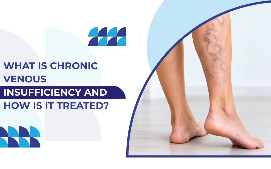 What Is Chronic Venous Insufficiency and How Is It Treated?