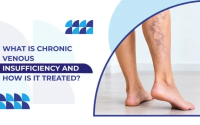 What Is Chronic Venous Insufficiency and How Is It Treated?